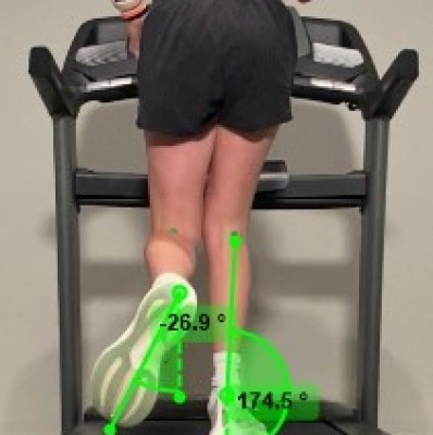 Case Study: Young Athlete Eliminates Knee Pain and Achieves Personal Record Through Targeted Intervention: 1 session Gait Analysis and Personalized Program